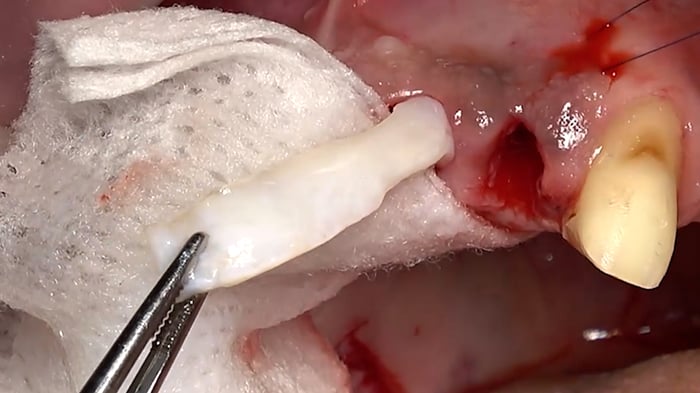 Ice_cream_cone_technique