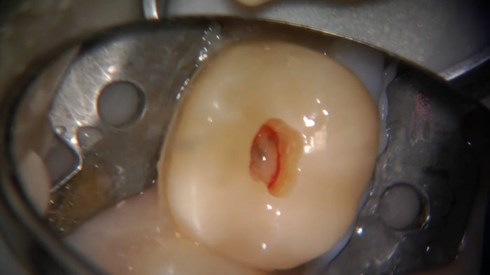 Terapia_canalare_molari_superiori