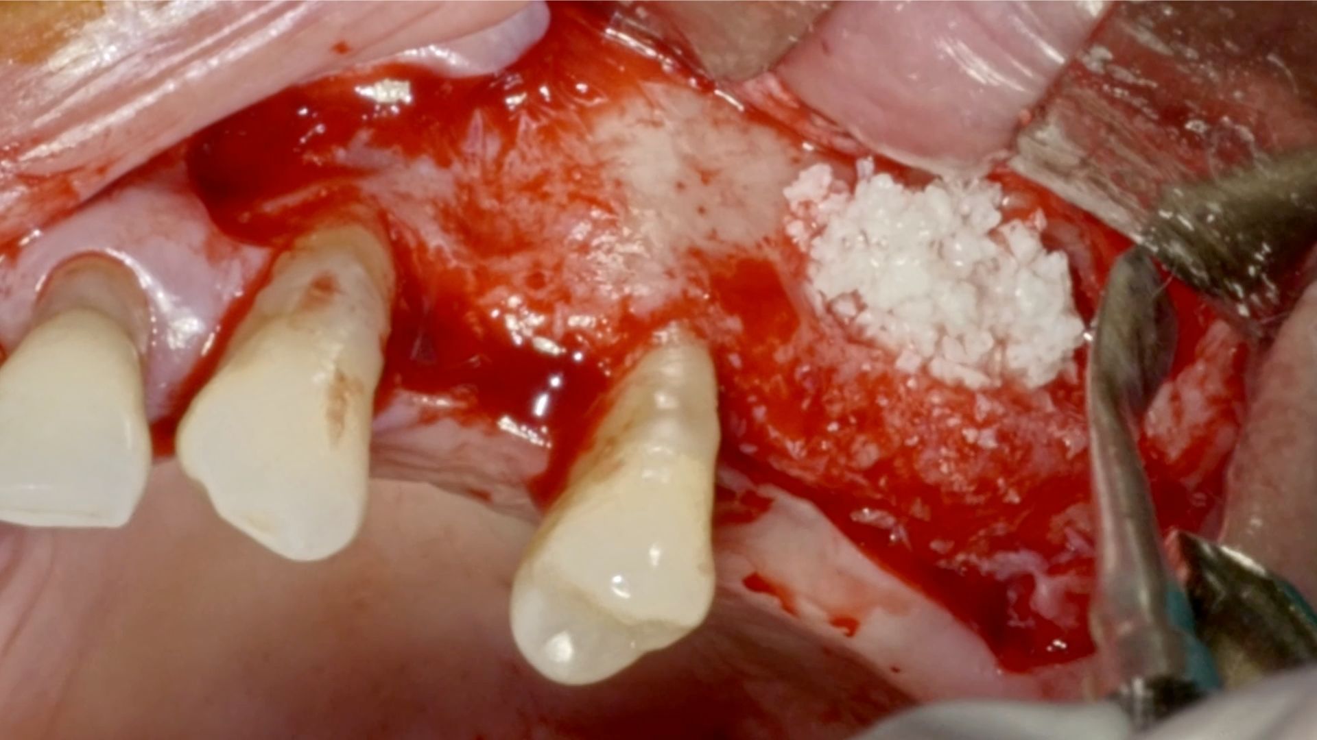 implantologia_dentale_odontoiatrica_parodontite_chirurgia_orale_rialzo_seno_mascellare